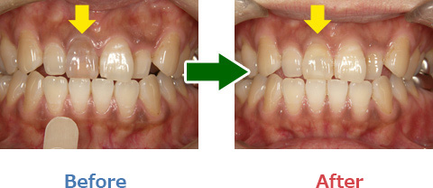 失活歯のホワイトニング写真